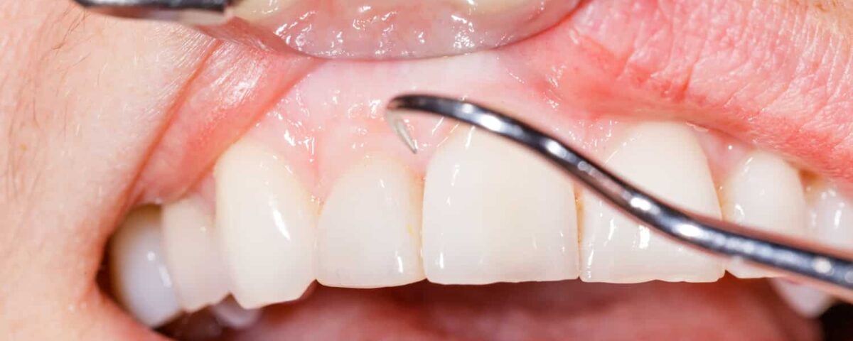 4 Treatments for Gum Disease