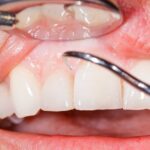 4 Treatments for Gum Disease