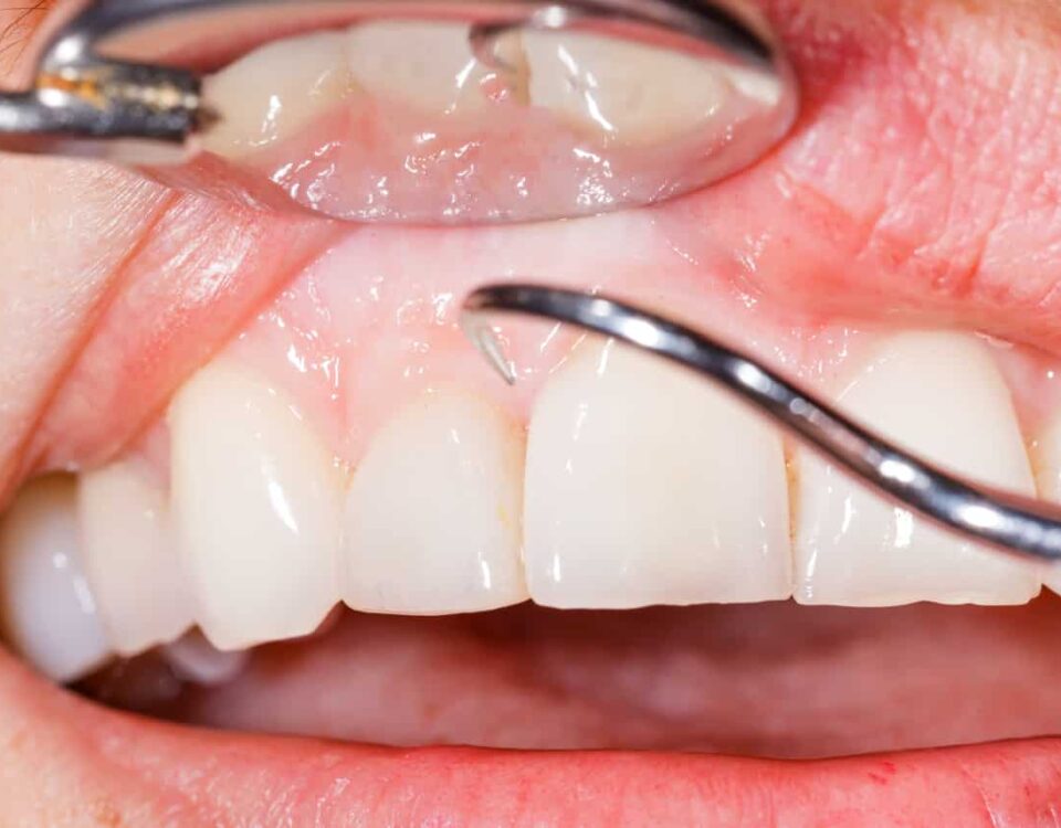 4 Treatments for Gum Disease