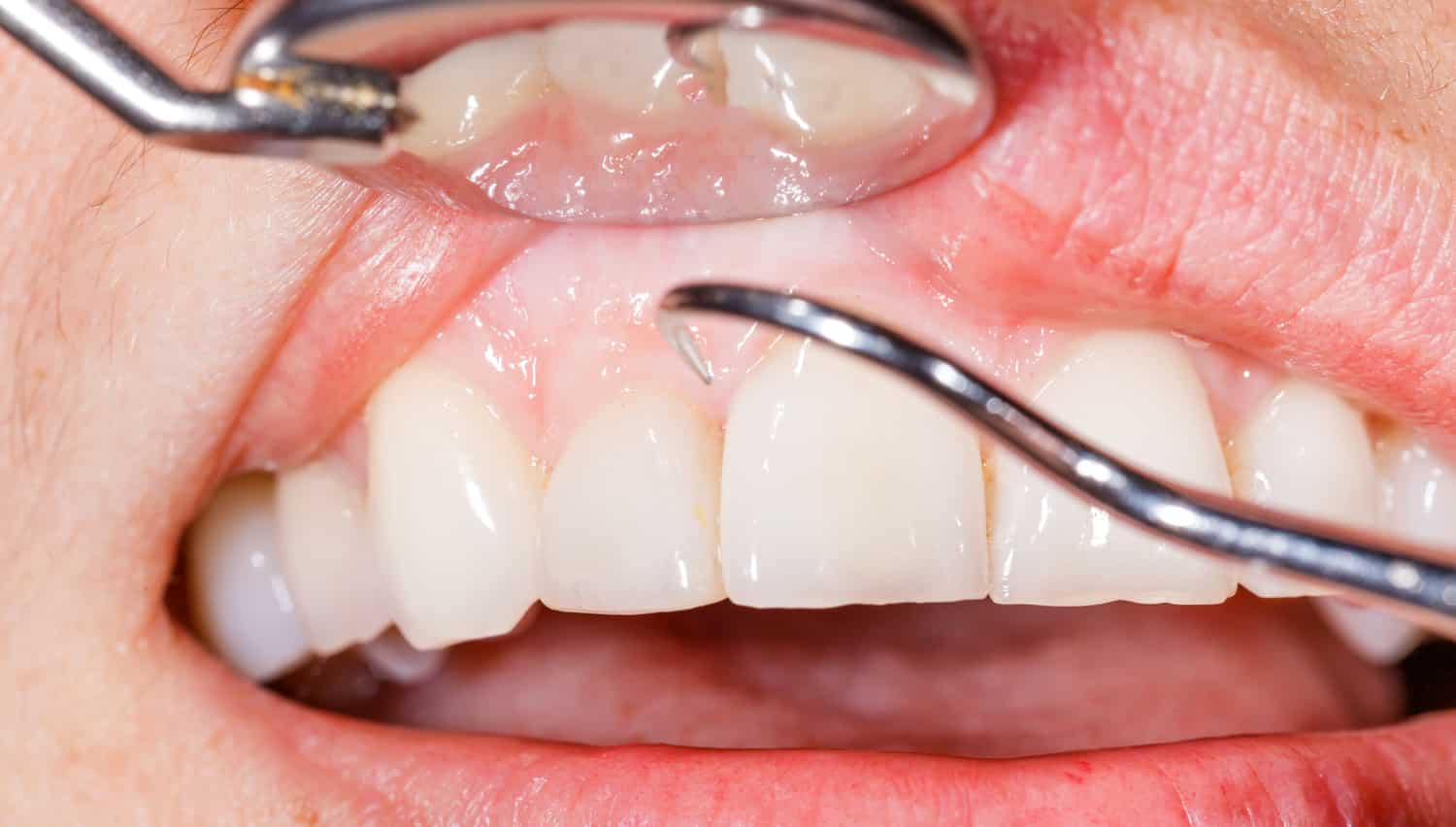 4 Treatments for Gum Disease
