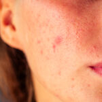 Can I Get Rid of Acne Scars?