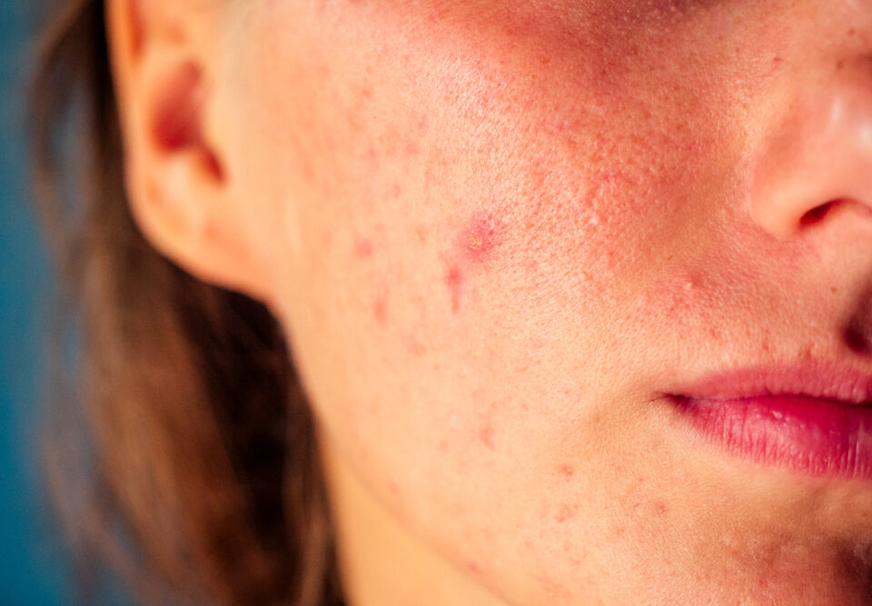 Can I Get Rid of Acne Scars?