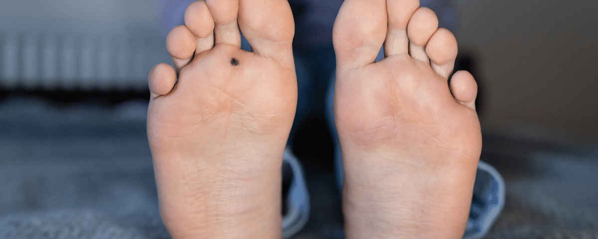 Effective Methods for Wart Removal