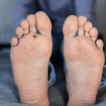 Effective Methods for Wart Removal