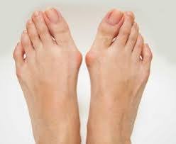 The Connection Between Bunions and Footwear Choices