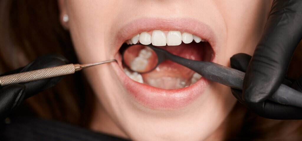 Understanding the Different Types of Dental Fillings