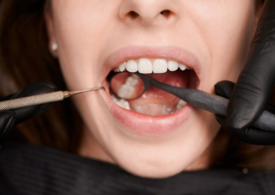 Understanding the Different Types of Dental Fillings