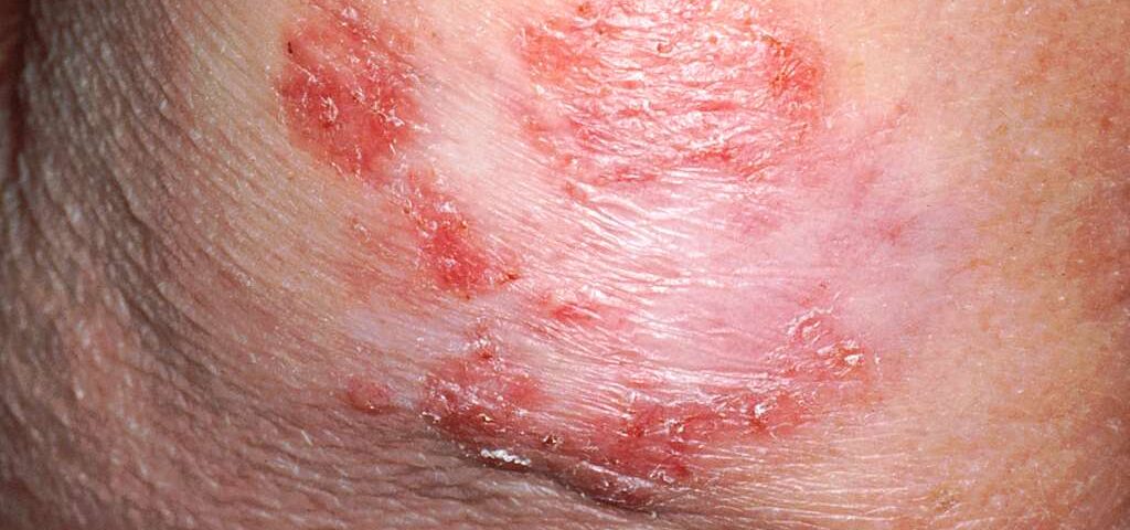 Early Warning Signs of Skin Cancer