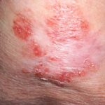 Early Warning Signs of Skin Cancer