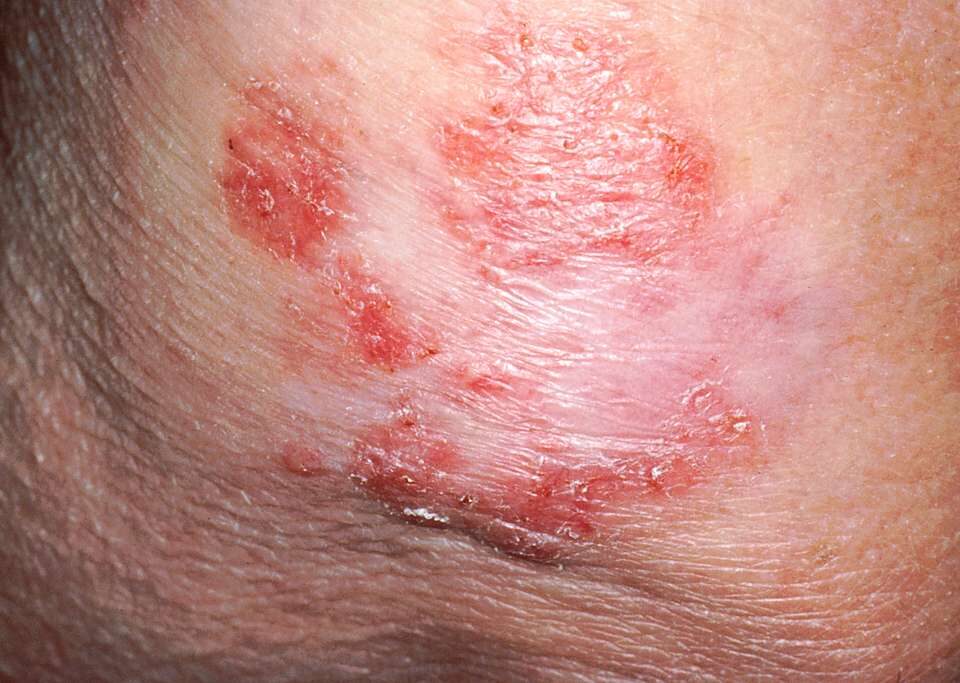 Early Warning Signs of Skin Cancer