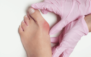 Exploring Treatments for Bunions