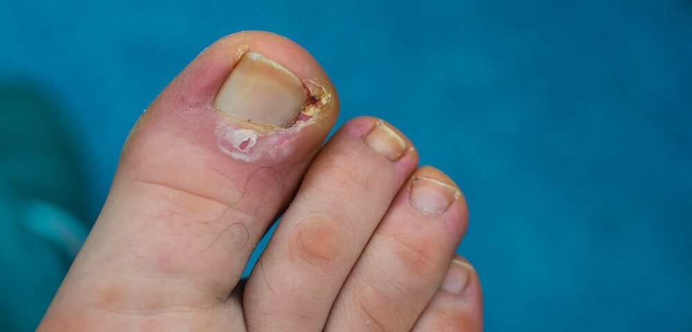 Ingrown Toenail Treatment: Preventing Complications