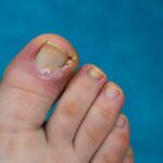 Ingrown Toenail Treatment: Preventing Complications