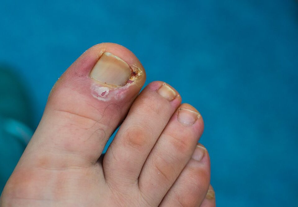 Ingrown Toenail Treatment: Preventing Complications
