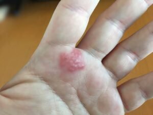 Recognizing the Early Signs of an Allergic Reaction