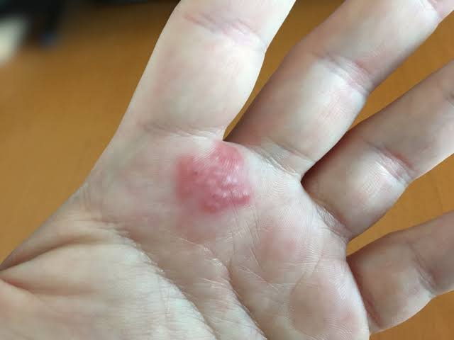 Recognizing the Early Signs of an Allergic Reaction