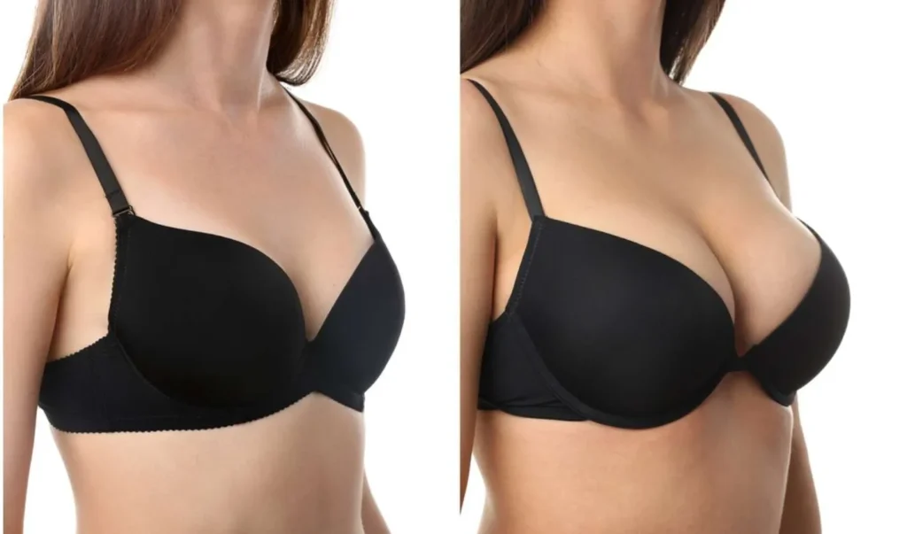 When to Consider Getting a Breast Lift