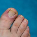Ingrown Toenail Treatment: Preventing Complications