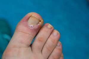Ingrown Toenail Treatment: Preventing Complications